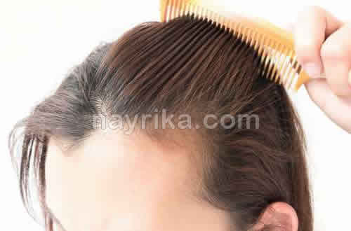 ریزش مو, جلوگیری از ریزش مو, مهمترین علت ریزش مو, علت ناگهانی ریزش مو, برای جلوگیری از ریزش مو چه بخوریم, جلوگیری از ریزش مو با روغن زیتون, علت ریزش مو در جوانان, شامپو برای جلوگیری از ریزش مو, درمان ریزش مو با آب پیاز, ریزش مو شدید, درمان خانگی ریزش مو و شوره سر, جلوگیری ریزش مو, ریزش مو شدید دارم, جلوگیری از ریزش موی سر ایا قرص اهن برای مو مفید است, آهن و رشد مو, قرص فولیک اسید برای ریزش مو, قرص آهن درمان ریزش مو