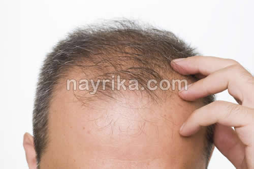 ریزش مو, جلوگیری از ریزش مو, مهمترین علت ریزش مو, علت ناگهانی ریزش مو, برای جلوگیری از ریزش مو چه بخوریم, جلوگیری از ریزش مو با روغن زیتون, علت ریزش مو در جوانان, شامپو برای جلوگیری از ریزش مو, درمان ریزش مو با آب پیاز, ریزش مو شدید, درمان خانگی ریزش مو و شوره سر, جلوگیری ریزش مو, ریزش مو شدید دارم, جلوگیری از ریزش موی سر ریزش مو / ریزش مو بدلیل کمبود آهن, ریزش مو ناشی از کمبود آهن, بهترین قرص آهن برای ریزش مو