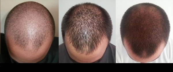فیناستراید / عوارض فیناستراید / فیناستراید برای مردان / فیناستراید برای زنان / فیناستراید برای ریزش مو / فیناستراید برای پروستات