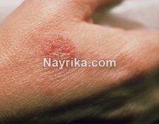 اگزما: عوارض، واگیر / انواع درمان اگزما: پماد، هویج و وازین / اگزما دست و در نوزادان