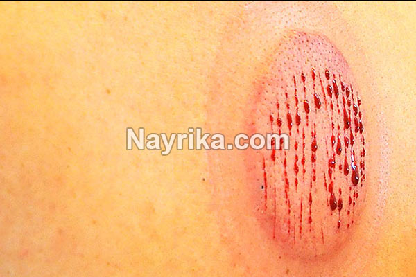 حجامت, حجامت چیست, روش حجامت, انواع حجامت, زمان حجامت, حجامت کبد, حجامت سر, خواص حجامت, عوارض حجامت, حجامت برای جوش صورت, حجامت برای لاغری, حجامت برای ریزش مو, حجامت برای کبد چرب, حجامت برای چاق شدن, حجامت برای لک صورت, حجامت فواید, عکس حجامت حجامت, حجامت چیست, روش حجامت, انواع حجامت, زمان حجامت, حجامت کبد, حجامت سر, خواص حجامت, عوارض حجامت, حجامت برای جوش صورت, حجامت برای لاغری, حجامت برای ریزش مو, حجامت برای کبد چرب, حجامت برای چاق شدن, حجامت برای لک صورت, حجامت فواید, عکس حجامت