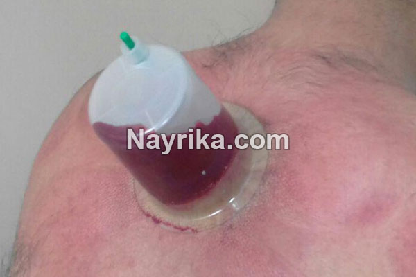 حجامت, حجامت چیست, روش حجامت, انواع حجامت, زمان حجامت, حجامت کبد, حجامت سر, خواص حجامت, عوارض حجامت, حجامت برای جوش صورت, حجامت برای لاغری, حجامت برای ریزش مو, حجامت برای کبد چرب, حجامت برای چاق شدن, حجامت برای لک صورت, حجامت فواید, عکس حجامت حجامت, حجامت چیست, روش حجامت, انواع حجامت, زمان حجامت, حجامت کبد, حجامت سر, خواص حجامت, عوارض حجامت, حجامت برای جوش صورت, حجامت برای لاغری, حجامت برای ریزش مو, حجامت برای کبد چرب, حجامت برای چاق شدن, حجامت برای لک صورت, حجامت فواید, عکس حجامت