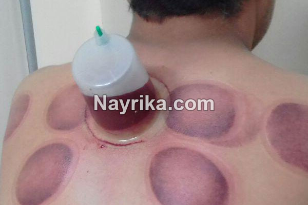 حجامت, حجامت چیست, روش حجامت, انواع حجامت, زمان حجامت, حجامت کبد, حجامت سر, خواص حجامت, عوارض حجامت, حجامت برای جوش صورت, حجامت برای لاغری, حجامت برای ریزش مو, حجامت برای کبد چرب, حجامت برای چاق شدن, حجامت برای لک صورت, حجامت فواید, عکس حجامت حجامت, حجامت چیست, روش حجامت, انواع حجامت, زمان حجامت, حجامت کبد, حجامت سر, خواص حجامت, عوارض حجامت, حجامت برای جوش صورت, حجامت برای لاغری, حجامت برای ریزش مو, حجامت برای کبد چرب, حجامت برای چاق شدن, حجامت برای لک صورت, حجامت فواید, عکس حجامت
