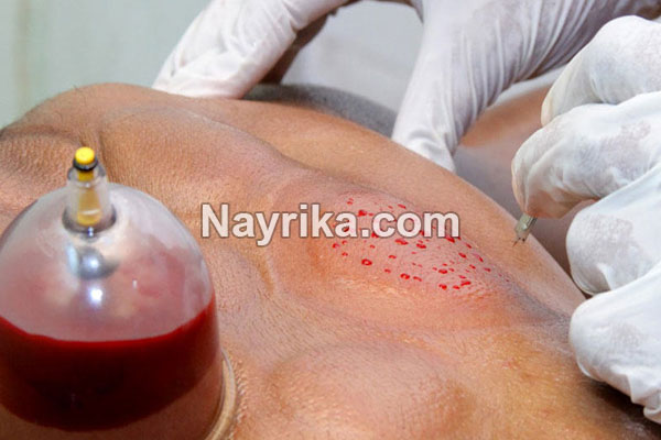 حجامت, حجامت چیست, روش حجامت, انواع حجامت, زمان حجامت, حجامت کبد, حجامت سر, خواص حجامت, عوارض حجامت, حجامت برای جوش صورت, حجامت برای لاغری, حجامت برای ریزش مو, حجامت برای کبد چرب, حجامت برای چاق شدن, حجامت برای لک صورت, حجامت فواید, عکس حجامت حجامت, حجامت چیست, روش حجامت, انواع حجامت, زمان حجامت, حجامت کبد, حجامت سر, خواص حجامت, عوارض حجامت, حجامت برای جوش صورت, حجامت برای لاغری, حجامت برای ریزش مو, حجامت برای کبد چرب, حجامت برای چاق شدن, حجامت برای لک صورت, حجامت فواید, عکس حجامت