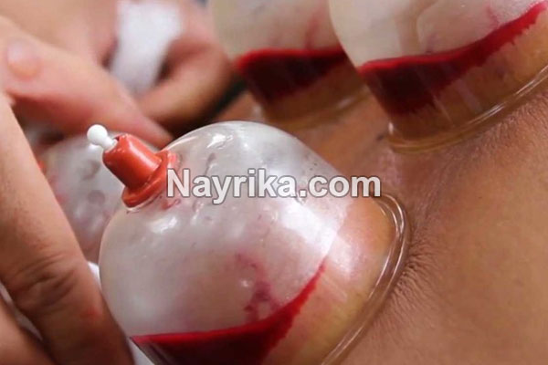 حجامت, حجامت چیست, روش حجامت, انواع حجامت, زمان حجامت, حجامت کبد, حجامت سر, خواص حجامت, عوارض حجامت, حجامت برای جوش صورت, حجامت برای لاغری, حجامت برای ریزش مو, حجامت برای کبد چرب, حجامت برای چاق شدن, حجامت برای لک صورت, حجامت فواید, عکس حجامت حجامت, حجامت چیست, روش حجامت, انواع حجامت, زمان حجامت, حجامت کبد, حجامت سر, خواص حجامت, عوارض حجامت, حجامت برای جوش صورت, حجامت برای لاغری, حجامت برای ریزش مو, حجامت برای کبد چرب, حجامت برای چاق شدن, حجامت برای لک صورت, حجامت فواید, عکس حجامت