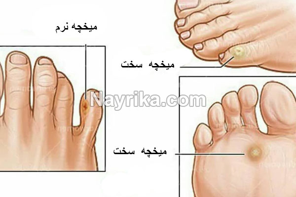 میخچه, میخچه چیست, علت میخچه, عوارض میخچه پا, درمان میخچه در منزل, درمان میخچه با پیاز, درمان دارویی میخچه, درمان میخچه با سیمان, درمان عفونت میخچه پا, عکس ریشه میخچه پا میخچه, میخچه چیست, علت میخچه, عوارض میخچه پا, درمان میخچه در منزل, درمان میخچه با پیاز, درمان دارویی میخچه, درمان میخچه با سیمان, درمان عفونت میخچه پا, عکس ریشه میخچه پا