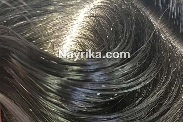 شپش, شپش چیست, طول عمر شپش سر, شپش بدن, دشمن شپش, درمان شپش با اسپند, درمان شپش با سرکه و نمک, درمان شپش با رنگ مو, درمان شپش با قران, درمان شپش سر با حنا, درمان شپش با پودر لباسشویی, درمان قطعی شپش با شامپو, درمان شپش سر با حنا, درمان شپش سر با سرکه, عکس شپش سر, شپش مکنده, شپش نر و ماده شپش, شپش چیست, طول عمر شپش سر, شپش بدن, دشمن شپش, درمان شپش با اسپند, درمان شپش با سرکه و نمک, درمان شپش با رنگ مو, درمان شپش با قران, درمان شپش سر با حنا, درمان شپش با پودر لباسشویی, درمان قطعی شپش با شامپو, درمان شپش سر با حنا, درمان شپش سر با سرکه, عکس شپش سر, شپش مکنده, شپش نر و ماده