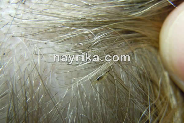شپش, شپش چیست, طول عمر شپش سر, شپش بدن, دشمن شپش, درمان شپش با اسپند, درمان شپش با سرکه و نمک, درمان شپش با رنگ مو, درمان شپش با قران, درمان شپش سر با حنا, درمان شپش با پودر لباسشویی, درمان قطعی شپش با شامپو, درمان شپش سر با حنا, درمان شپش سر با سرکه, عکس شپش سر, شپش مکنده, شپش نر و ماده شپش, شپش چیست, طول عمر شپش سر, شپش بدن, دشمن شپش, درمان شپش با اسپند, درمان شپش با سرکه و نمک, درمان شپش با رنگ مو, درمان شپش با قران, درمان شپش سر با حنا, درمان شپش با پودر لباسشویی, درمان قطعی شپش با شامپو, درمان شپش سر با حنا, درمان شپش سر با سرکه, عکس شپش سر, شپش مکنده, شپش نر و ماده