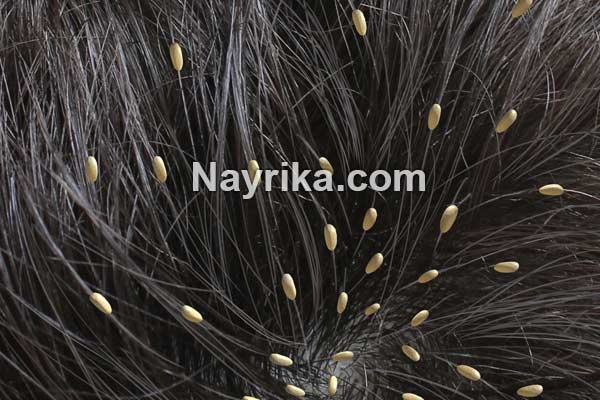 شپش, شپش چیست, طول عمر شپش سر, شپش بدن, دشمن شپش, درمان شپش با اسپند, درمان شپش با سرکه و نمک, درمان شپش با رنگ مو, درمان شپش با قران, درمان شپش سر با حنا, درمان شپش با پودر لباسشویی, درمان قطعی شپش با شامپو, درمان شپش سر با حنا, درمان شپش سر با سرکه, عکس شپش سر, شپش مکنده, شپش نر و ماده شپش, شپش چیست, طول عمر شپش سر, شپش بدن, دشمن شپش, درمان شپش با اسپند, درمان شپش با سرکه و نمک, درمان شپش با رنگ مو, درمان شپش با قران, درمان شپش سر با حنا, درمان شپش با پودر لباسشویی, درمان قطعی شپش با شامپو, درمان شپش سر با حنا, درمان شپش سر با سرکه, عکس شپش سر, شپش مکنده, شپش نر و ماده