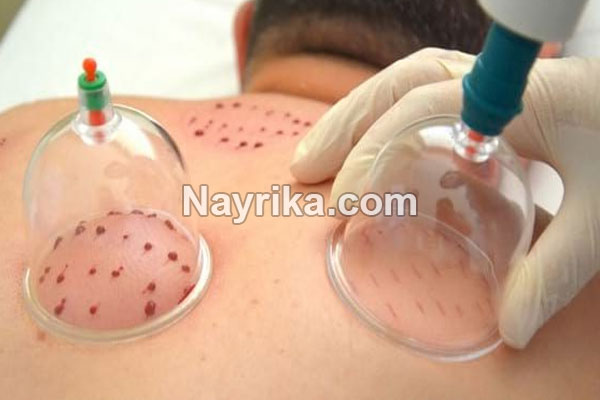 حجامت, حجامت چیست, روش حجامت, انواع حجامت, زمان حجامت, حجامت کبد, حجامت سر, خواص حجامت, عوارض حجامت, حجامت برای جوش صورت, حجامت برای لاغری, حجامت برای ریزش مو, حجامت برای کبد چرب, حجامت برای چاق شدن, حجامت برای لک صورت, حجامت فواید, عکس حجامت حجامت, حجامت چیست, روش حجامت, انواع حجامت, زمان حجامت, حجامت کبد, حجامت سر, خواص حجامت, عوارض حجامت, حجامت برای جوش صورت, حجامت برای لاغری, حجامت برای ریزش مو, حجامت برای کبد چرب, حجامت برای چاق شدن, حجامت برای لک صورت, حجامت فواید, عکس حجامت