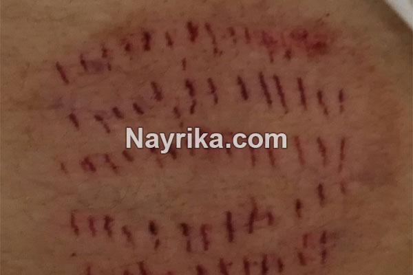 حجامت, حجامت چیست, روش حجامت, انواع حجامت, زمان حجامت, حجامت کبد, حجامت سر, خواص حجامت, عوارض حجامت, حجامت برای جوش صورت, حجامت برای لاغری, حجامت برای ریزش مو, حجامت برای کبد چرب, حجامت برای چاق شدن, حجامت برای لک صورت, حجامت فواید, عکس حجامت حجامت, حجامت چیست, روش حجامت, انواع حجامت, زمان حجامت, حجامت کبد, حجامت سر, خواص حجامت, عوارض حجامت, حجامت برای جوش صورت, حجامت برای لاغری, حجامت برای ریزش مو, حجامت برای کبد چرب, حجامت برای چاق شدن, حجامت برای لک صورت, حجامت فواید, عکس حجامت