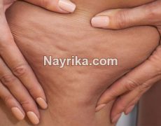 سلولیت : درمان خانگی و درمان دارویی سلولیت / درمان سلولیت با قهوه و لیزر و کرم سلولیت : درمان خانگی و درمان دارویی سلولیت / درمان سلولیت با قهوه و لیزر و کرم