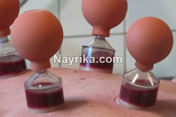 حجامت, حجامت چیست, روش حجامت, انواع حجامت, زمان حجامت, حجامت کبد, حجامت سر, خواص حجامت, عوارض حجامت, حجامت برای جوش صورت, حجامت برای لاغری, حجامت برای ریزش مو, حجامت برای کبد چرب, حجامت برای چاق شدن, حجامت برای لک صورت, حجامت فواید, عکس حجامت حجامت, حجامت چیست, روش حجامت, انواع حجامت, زمان حجامت, حجامت کبد, حجامت سر, خواص حجامت, عوارض حجامت, حجامت برای جوش صورت, حجامت برای لاغری, حجامت برای ریزش مو, حجامت برای کبد چرب, حجامت برای چاق شدن, حجامت برای لک صورت, حجامت فواید, عکس حجامت