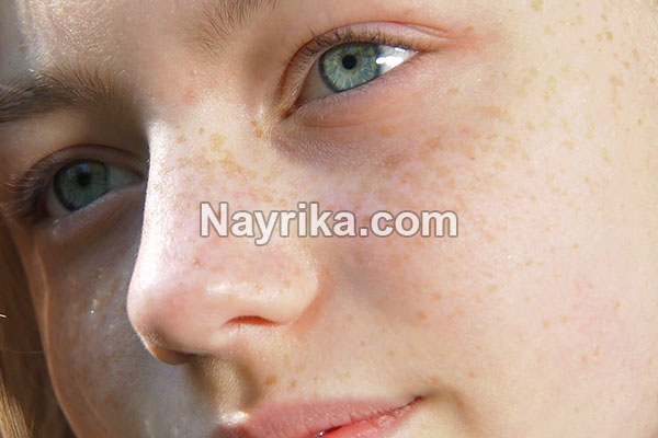 کک و مک, کک و مک چیست, علت ایجاد کک و مک, درمان کک و مک ارثی, بهترین کرم برای رفع کک و مک, آلوورا برای کک و مک, ماسک عسل و دارچین برای کک و مک, درمان کک و مک با لیزر, هزینه لیزر کک و مک صورت, چرا کک و مک میزنیم کک و مک, کک و مک چیست, علت ایجاد کک و مک, درمان کک و مک ارثی, بهترین کرم برای رفع کک و مک, آلوورا برای کک و مک, ماسک عسل و دارچین برای کک و مک, درمان کک و مک با لیزر, هزینه لیزر کک و مک صورت, چرا کک و مک میزنیم