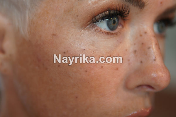 کک و مک, کک و مک چیست, علت ایجاد کک و مک, درمان کک و مک ارثی, بهترین کرم برای رفع کک و مک, آلوورا برای کک و مک, ماسک عسل و دارچین برای کک و مک, درمان کک و مک با لیزر, هزینه لیزر کک و مک صورت, چرا کک و مک میزنیم کک و مک, کک و مک چیست, علت ایجاد کک و مک, درمان کک و مک ارثی, بهترین کرم برای رفع کک و مک, آلوورا برای کک و مک, ماسک عسل و دارچین برای کک و مک, درمان کک و مک با لیزر, هزینه لیزر کک و مک صورت, چرا کک و مک میزنیم