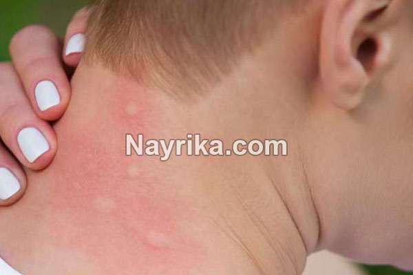 راش, راش بدن چیست, راش پوستی کودک, راش پوستی نوزاد, راش پوستی واژن, درمان خانگی راش پوستی, درمان راش پوستی چیست, عکس راش پوستی ایدز راش, راش بدن چیست, راش پوستی کودک, راش پوستی نوزاد, راش پوستی واژن, درمان خانگی راش پوستی, درمان راش پوستی چیست, عکس راش پوستی ایدز