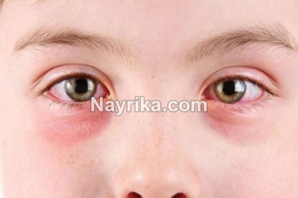 پف زیر چشم, علت پف زیر چشم, پف زیر چشم و کبد, کم خونی و پف زیر چشم, کرم رفع پف زیر چشم, پف زیر چشم کودکان دلیلش چیست, درمان چروک و پف زیر چشم, علت ورم ناگهانی زیر چشم, چه عواملی باعث پف زیر چشم میشود, کرمی برای پف زیر چشم پف زیر چشم, علت پف زیر چشم, پف زیر چشم و کبد, کم خونی و پف زیر چشم, کرم رفع پف زیر چشم, پف زیر چشم کودکان دلیلش چیست, درمان چروک و پف زیر چشم, علت ورم ناگهانی زیر چشم, چه عواملی باعث پف زیر چشم میشود, کرمی برای پف زیر چشم