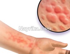 کهیر: شکل ظاهری و درمان / کهیر در کودکان / کهیر واسکولیتی / کهیر و سرطان