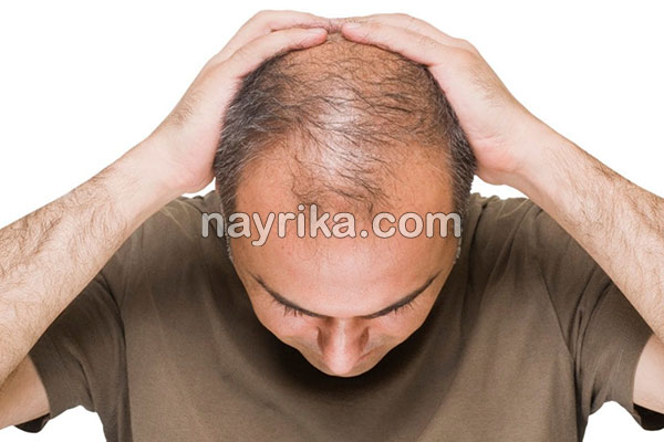 ریزش مو, جلوگیری از ریزش مو, مهمترین علت ریزش مو, علت ناگهانی ریزش مو, برای جلوگیری از ریزش مو چه بخوریم, جلوگیری از ریزش مو با روغن زیتون, علت ریزش مو در جوانان, شامپو برای جلوگیری از ریزش مو, درمان ریزش مو با آب پیاز, ریزش مو شدید, درمان خانگی ریزش مو و شوره سر, جلوگیری ریزش مو, ریزش مو شدید دارم, جلوگیری از ریزش موی سر ریزش مو, جلوگیری از ریزش مو, مهمترین علت ریزش مو, علت ناگهانی ریزش مو, برای جلوگیری از ریزش مو چه بخوریم, جلوگیری از ریزش مو با روغن زیتون, علت ریزش مو در جوانان, شامپو برای جلوگیری از ریزش مو, درمان ریزش مو با آب پیاز, ریزش مو شدید, درمان خانگی ریزش مو و شوره سر, جلوگیری ریزش مو, ریزش مو شدید دارم, جلوگیری از ریزش موی سر