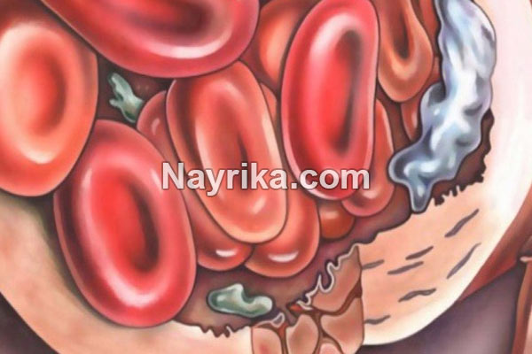کم خونی, کم خونی چیست, انواع کم خونی, علائم ظاهری کم خونی, درمان کم خونی در طب سنتی, علائم سردرد کم خونی, کم خونی مینور, علائم کم خونی در کودکان, شایع ترین علائم کم خونی, علائم کم خونی در مردان, درمان کم خونی با عسل, درمان کم خونی با داروهای گیاهی, درمان کم خونی کودکان, درمان کم خونی در مردان, درمان کم خونی مینور, درمان کم خونی دکتر روازاده, درمان کم خونی تبریزیان کم خونی, کم خونی چیست, انواع کم خونی, علائم ظاهری کم خونی, درمان کم خونی در طب سنتی, علائم سردرد کم خونی, کم خونی مینور, علائم کم خونی در کودکان, شایع ترین علائم کم خونی, علائم کم خونی در مردان, درمان کم خونی با عسل, درمان کم خونی با داروهای گیاهی, درمان کم خونی کودکان, درمان کم خونی در مردان, درمان کم خونی مینور, درمان کم خونی دکتر روازاده, درمان کم خونی تبریزیان