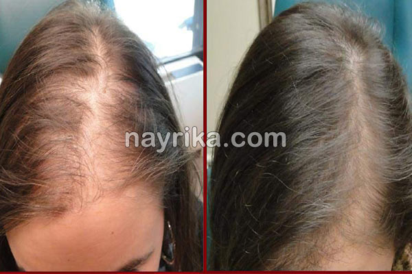 ریزش مو, جلوگیری از ریزش مو, مهمترین علت ریزش مو, علت ناگهانی ریزش مو, برای جلوگیری از ریزش مو چه بخوریم, جلوگیری از ریزش مو با روغن زیتون, علت ریزش مو در جوانان, شامپو برای جلوگیری از ریزش مو, درمان ریزش مو با آب پیاز, ریزش مو شدید, درمان خانگی ریزش مو و شوره سر, جلوگیری ریزش مو, ریزش مو شدید دارم, جلوگیری از ریزش موی سر ریزش مو, جلوگیری از ریزش مو, مهمترین علت ریزش مو, علت ناگهانی ریزش مو, برای جلوگیری از ریزش مو چه بخوریم, جلوگیری از ریزش مو با روغن زیتون, علت ریزش مو در جوانان, شامپو برای جلوگیری از ریزش مو, درمان ریزش مو با آب پیاز, ریزش مو شدید, درمان خانگی ریزش مو و شوره سر, جلوگیری ریزش مو, ریزش مو شدید دارم, جلوگیری از ریزش موی سر