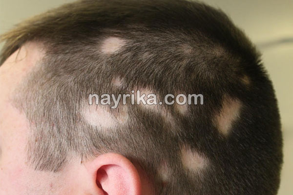 ریزش مو, جلوگیری از ریزش مو, مهمترین علت ریزش مو, علت ناگهانی ریزش مو, برای جلوگیری از ریزش مو چه بخوریم, جلوگیری از ریزش مو با روغن زیتون, علت ریزش مو در جوانان, شامپو برای جلوگیری از ریزش مو, درمان ریزش مو با آب پیاز, ریزش مو شدید, درمان خانگی ریزش مو و شوره سر, جلوگیری ریزش مو, ریزش مو شدید دارم, جلوگیری از ریزش موی سر ریزش مو, جلوگیری از ریزش مو, مهمترین علت ریزش مو, علت ناگهانی ریزش مو, برای جلوگیری از ریزش مو چه بخوریم, جلوگیری از ریزش مو با روغن زیتون, علت ریزش مو در جوانان, شامپو برای جلوگیری از ریزش مو, درمان ریزش مو با آب پیاز, ریزش مو شدید, درمان خانگی ریزش مو و شوره سر, جلوگیری ریزش مو, ریزش مو شدید دارم, جلوگیری از ریزش موی سر