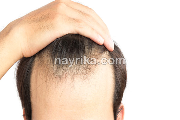 ریزش مو, جلوگیری از ریزش مو, مهمترین علت ریزش مو, علت ناگهانی ریزش مو, برای جلوگیری از ریزش مو چه بخوریم, جلوگیری از ریزش مو با روغن زیتون, علت ریزش مو در جوانان, شامپو برای جلوگیری از ریزش مو, درمان ریزش مو با آب پیاز, ریزش مو شدید, درمان خانگی ریزش مو و شوره سر, جلوگیری ریزش مو, ریزش مو شدید دارم, جلوگیری از ریزش موی سر ریزش مو, جلوگیری از ریزش مو, مهمترین علت ریزش مو, علت ناگهانی ریزش مو, برای جلوگیری از ریزش مو چه بخوریم, جلوگیری از ریزش مو با روغن زیتون, علت ریزش مو در جوانان, شامپو برای جلوگیری از ریزش مو, درمان ریزش مو با آب پیاز, ریزش مو شدید, درمان خانگی ریزش مو و شوره سر, جلوگیری ریزش مو, ریزش مو شدید دارم, جلوگیری از ریزش موی سر
