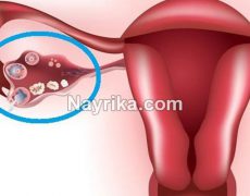 کیست تخمدان: علائم در پریودی، اندازه و جراحی / درمان گیاهی کیست تخمدان کیست تخمدان: علائم در پریودی، اندازه و جراحی / درمان گیاهی کیست تخمدان