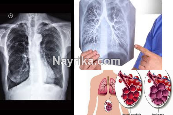 برونشیت, برونشیت چیست, علائم برونشیت, درمان قطعی برونشیت مزمن, برونشیت در کودکان, آیا برونشیت مسری است؟, برونشیت حاد چیست, برونشیت در نوزادان, آنتی بیوتیک برای برونشیت, درمان برونشیت در طب سنتی برونشیت, برونشیت چیست, علائم برونشیت, درمان قطعی برونشیت مزمن, برونشیت در کودکان, آیا برونشیت مسری است؟, برونشیت حاد چیست, برونشیت در نوزادان, آنتی بیوتیک برای برونشیت, درمان برونشیت در طب سنتی