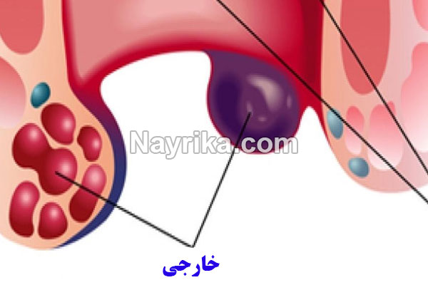 بواسیر, بواسیر چیست, علائم بواسیر, درمان بواسیر, درمان بواسیر خونی, درمان بواسیر خارجی, درمان بواسیر در زنان, بهترین میوه برای درمان بواسیر, درمان بواسیر در طب سنتی, سیر و درمان بواسیر, درمان بواسیر با روغن زیتون, درمان بواسیر با حنا, درمان بواسیر با روغن زیتون بواسیر, بواسیر چیست, علائم بواسیر, درمان بواسیر, درمان بواسیر خونی, درمان بواسیر خارجی, درمان بواسیر در زنان, بهترین میوه برای درمان بواسیر, درمان بواسیر در طب سنتی, سیر و درمان بواسیر, درمان بواسیر با روغن زیتون, درمان بواسیر با حنا, درمان بواسیر با روغن زیتون