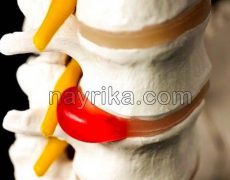 دیسک کمر: تشخیص، نحوه استراحت برای درد، ورزش، بهترین درمان دیسک کمر