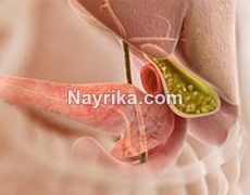 سنگ کیسه صفرا: اندازه طبیعی، علت، عوارض، جلوگیری و درمان در طب سنتی سنگ کیسه صفرا: اندازه طبیعی، علت، عوارض، جلوگیری و درمان در طب سنتی