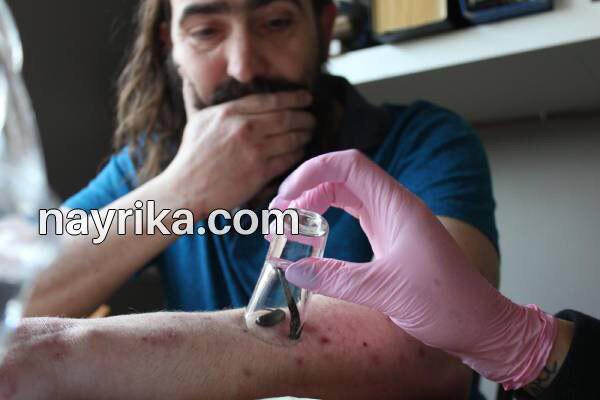 زالو درمانی, زالو درمانی چیست, آموزش زالو درمانی, زالو درمانی صورت, عوارض احتمالی زالو درمانی, زالو درمانی پشت گوش, عوارض بعد از زالو درمانی, چه کسانی نباید زالو درمانی کنند, عکس زالو درمانی زالو درمانی, زالو درمانی چیست, آموزش زالو درمانی, زالو درمانی صورت, عوارض احتمالی زالو درمانی, زالو درمانی پشت گوش, عوارض بعد از زالو درمانی, چه کسانی نباید زالو درمانی کنند, عکس زالو درمانی