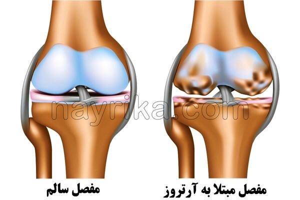 آرتروز, آرتروز چیست, علائم آرتروز, انواع آرتروز, آرتروز دست, آرتروز گردن, آرتروز زانو چیست, درمان آرتروز, درمان گیاهی آرتروز, برای درمان آرتروز چه باید کرد, قرص آرتروز زانو, درمان آرتروز دست, درمان آرتروز پا, درمان آرتروز گردن, درمان آرتروز کمر, برای درمان ارتروز چه بخوریم, درمان سنتی آرتروز, غذاهای ضد ارتروز آرتروز, آرتروز چیست, علائم آرتروز, انواع آرتروز, آرتروز دست, آرتروز گردن, آرتروز زانو چیست, درمان آرتروز, درمان گیاهی آرتروز, برای درمان آرتروز چه باید کرد, قرص آرتروز زانو, درمان آرتروز دست, درمان آرتروز پا, درمان آرتروز گردن, درمان آرتروز کمر, برای درمان ارتروز چه بخوریم, درمان سنتی آرتروز, غذاهای ضد ارتروز