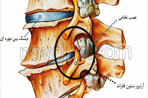 آرتروز, آرتروز چیست, علائم آرتروز, انواع آرتروز, آرتروز دست, آرتروز گردن, آرتروز زانو چیست, درمان آرتروز, درمان گیاهی آرتروز, برای درمان آرتروز چه باید کرد, قرص آرتروز زانو, درمان آرتروز دست, درمان آرتروز پا, درمان آرتروز گردن, درمان آرتروز کمر, برای درمان ارتروز چه بخوریم, درمان سنتی آرتروز, غذاهای ضد ارتروز آرتروز, آرتروز چیست, علائم آرتروز, انواع آرتروز, آرتروز دست, آرتروز گردن, آرتروز زانو چیست, درمان آرتروز, درمان گیاهی آرتروز, برای درمان آرتروز چه باید کرد, قرص آرتروز زانو, درمان آرتروز دست, درمان آرتروز پا, درمان آرتروز گردن, درمان آرتروز کمر, برای درمان ارتروز چه بخوریم, درمان سنتی آرتروز, غذاهای ضد ارتروز