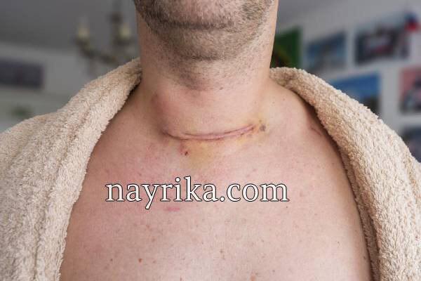 تیروئید پرکار, پرکاری تیروئید چیست, علائم تیروئید پر کار, تیروئید پرکار چه خطراتی دارد, درمان تیروئید پرکار, درمان تیروئید پرکار در طب سنتی, درمان خانگی تیروئید پرکار, درمان تیروئید پرکار با اسپند, علت بوجود امدن تیروئید پرکار, تیروئید پرکار در بارداری, علائم پر کاری تیروئید, تیروئید پرکار چه ضرری دارد, علایم تیروئید پرکار, علایم تیرویید پرکار, پرکاری تیروئید تیروئید پرکار, پرکاری تیروئید چیست, علائم تیروئید پر کار, تیروئید پرکار چه خطراتی دارد, درمان تیروئید پرکار, درمان تیروئید پرکار در طب سنتی, درمان خانگی تیروئید پرکار, درمان تیروئید پرکار با اسپند, علت بوجود امدن تیروئید پرکار, تیروئید پرکار در بارداری, علائم پر کاری تیروئید, تیروئید پرکار چه ضرری دارد, علایم تیروئید پرکار, علایم تیرویید پرکار, پرکاری تیروئید