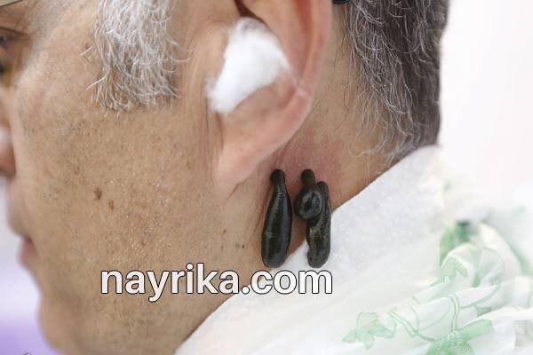 زالو درمانی, زالو درمانی چیست, آموزش زالو درمانی, زالو درمانی صورت, عوارض احتمالی زالو درمانی, زالو درمانی پشت گوش, عوارض بعد از زالو درمانی, چه کسانی نباید زالو درمانی کنند, عکس زالو درمانی زالو درمانی, زالو درمانی چیست, آموزش زالو درمانی, زالو درمانی صورت, عوارض احتمالی زالو درمانی, زالو درمانی پشت گوش, عوارض بعد از زالو درمانی, چه کسانی نباید زالو درمانی کنند, عکس زالو درمانی