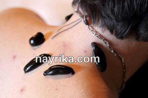 زالو درمانی, زالو درمانی چیست, آموزش زالو درمانی, زالو درمانی صورت, عوارض احتمالی زالو درمانی, زالو درمانی پشت گوش, عوارض بعد از زالو درمانی, چه کسانی نباید زالو درمانی کنند, عکس زالو درمانی زالو درمانی, زالو درمانی چیست, آموزش زالو درمانی, زالو درمانی صورت, عوارض احتمالی زالو درمانی, زالو درمانی پشت گوش, عوارض بعد از زالو درمانی, چه کسانی نباید زالو درمانی کنند, عکس زالو درمانی