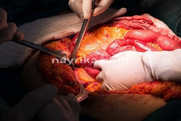 لاپاراتومی, لاپاراتومی چیست, عوارض لاپاراتومی, آمادگی قبل از عمل لاپاراتومی, مراقبت های بعد از عمل لاپاراتومی, مینی لاپاراتومی, لاپاراتومی کیست تخمدان, لاپاراتومی میومکتومی, عمل لاپاراتومی فیبروم, مراقبت های بعد از عمل لاپاراتومی کیست تخمدان, عمل لاپاراتومی شکم لاپاراتومی, لاپاراتومی چیست, عوارض لاپاراتومی, آمادگی قبل از عمل لاپاراتومی, مراقبت های بعد از عمل لاپاراتومی, مینی لاپاراتومی, لاپاراتومی کیست تخمدان, لاپاراتومی میومکتومی, عمل لاپاراتومی فیبروم, مراقبت های بعد از عمل لاپاراتومی کیست تخمدان, عمل لاپاراتومی شکم