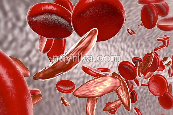 تالاسمی, تالاسمی چیست, انواع تالاسمی, علائم تالاسمی, درمان تالاسمی, تالاسمی آلفا+ازدواج, تالاسمی مینور ازدواج, تالاسمی مینور و بارداری, تالاسمی بتا, تالاسمی آلفا, علائم تالاسمی مینور در بزرگسالان, ازدواج تالاسمی آلفا و بتا, نشانه های ظاهری تالاسمی مینور, از کجا بفهمم تالاسمی دارم