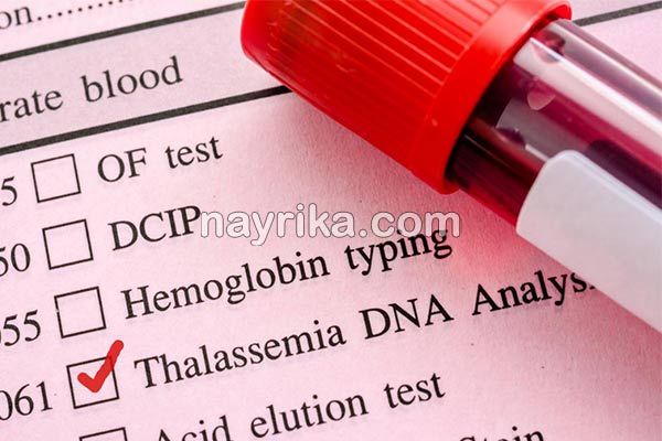 تالاسمی, تالاسمی چیست, انواع تالاسمی, علائم تالاسمی, درمان تالاسمی, تالاسمی آلفا+ازدواج, تالاسمی مینور ازدواج, تالاسمی مینور و بارداری, تالاسمی بتا, تالاسمی آلفا, علائم تالاسمی مینور در بزرگسالان, ازدواج تالاسمی آلفا و بتا, نشانه های ظاهری تالاسمی مینور, از کجا بفهمم تالاسمی دارم