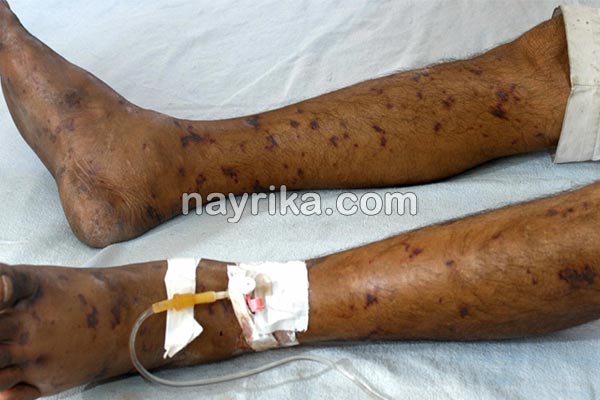 مننژیت, مننژیت چیست, علائم مننژیت, تشخیص مننژیت, مننژیت در نوزادان, واکسن مننژیت, پیشگیری از مننژیت, انواع مننژیت, درمان گیاهی مننژیت, آیا بیماری مننژیت کشنده است مننژیت, مننژیت چیست, علائم مننژیت, تشخیص مننژیت, مننژیت در نوزادان, واکسن مننژیت, پیشگیری از مننژیت, انواع مننژیت, درمان گیاهی مننژیت, آیا بیماری مننژیت کشنده است