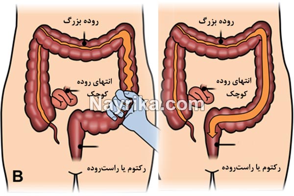 سندرم روده تحریک پذیر, سندرم روده تحریک پذیر چیست, علائم سندرم روده تحریک پذیر, تشخیص سندرم روده تحریک پذیر, درمان دارویی سندرم روده تحریک پذیر, درمان گیاهی سندرم روده تحریک پذیر, درمان قطعی سندرم روده تحریک پذیر, مواد غذایی مفید برای سندرم روده تحریک پذیر, سندرم روده تحریک پذیر و لاغری, درمان سندرم روده تحریک پذیر, عسل برای روده تحریک پذیر, درمان جدید روده تحریک پذیر, رازیانه و روده تحریک پذیر, درمان سندروم روده تحریک پذیر سندرم روده تحریک پذیر, سندرم روده تحریک پذیر چیست, علائم سندرم روده تحریک پذیر, تشخیص سندرم روده تحریک پذیر, درمان دارویی سندرم روده تحریک پذیر, درمان گیاهی سندرم روده تحریک پذیر, درمان قطعی سندرم روده تحریک پذیر, مواد غذایی مفید برای سندرم روده تحریک پذیر, سندرم روده تحریک پذیر و لاغری, درمان سندرم روده تحریک پذیر, عسل برای روده تحریک پذیر, درمان جدید روده تحریک پذیر, رازیانه و روده تحریک پذیر, درمان سندروم روده تحریک پذیر