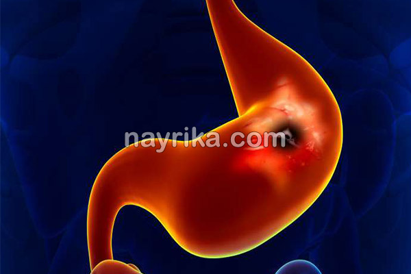 سرطان معده, سن سرطان معده, تشخیص سرطان معده, علائم اولیه سرطان معده, درمان سرطان معده, سرطان معده خوش خیم, طول عمر سرطان معده, درمان سرطان معده در طب سنتی, از کجا بفهمیم سرطان معده داریم, سرطان معده را چگونه تشخیص دهیم, علائم سرطان معده سرطان معده, سن سرطان معده, تشخیص سرطان معده, علائم اولیه سرطان معده, درمان سرطان معده, سرطان معده خوش خیم, طول عمر سرطان معده, درمان سرطان معده در طب سنتی, از کجا بفهمیم سرطان معده داریم, سرطان معده را چگونه تشخیص دهیم, علائم سرطان معده