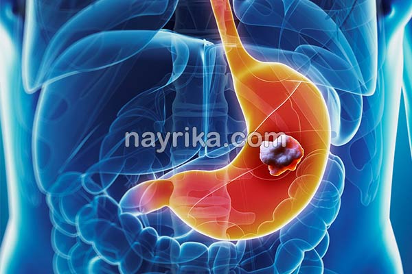 سرطان معده, سن سرطان معده, تشخیص سرطان معده, علائم اولیه سرطان معده, درمان سرطان معده, سرطان معده خوش خیم, طول عمر سرطان معده, درمان سرطان معده در طب سنتی, از کجا بفهمیم سرطان معده داریم, سرطان معده را چگونه تشخیص دهیم, علائم سرطان معده سرطان معده, سن سرطان معده, تشخیص سرطان معده, علائم اولیه سرطان معده, درمان سرطان معده, سرطان معده خوش خیم, طول عمر سرطان معده, درمان سرطان معده در طب سنتی, از کجا بفهمیم سرطان معده داریم, سرطان معده را چگونه تشخیص دهیم, علائم سرطان معده