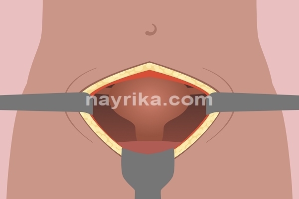 لاپاراتومی, لاپاراتومی چیست, عوارض لاپاراتومی, آمادگی قبل از عمل لاپاراتومی, مراقبت های بعد از عمل لاپاراتومی, مینی لاپاراتومی, لاپاراتومی کیست تخمدان, لاپاراتومی میومکتومی, عمل لاپاراتومی فیبروم, مراقبت های بعد از عمل لاپاراتومی کیست تخمدان, عمل لاپاراتومی شکم لاپاراتومی, لاپاراتومی چیست, عوارض لاپاراتومی, آمادگی قبل از عمل لاپاراتومی, مراقبت های بعد از عمل لاپاراتومی, مینی لاپاراتومی, لاپاراتومی کیست تخمدان, لاپاراتومی میومکتومی, عمل لاپاراتومی فیبروم, مراقبت های بعد از عمل لاپاراتومی کیست تخمدان, عمل لاپاراتومی شکم