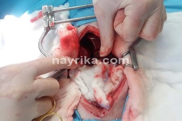 لاپاراتومی, لاپاراتومی چیست, عوارض لاپاراتومی, آمادگی قبل از عمل لاپاراتومی, مراقبت های بعد از عمل لاپاراتومی, مینی لاپاراتومی, لاپاراتومی کیست تخمدان, لاپاراتومی میومکتومی, عمل لاپاراتومی فیبروم, مراقبت های بعد از عمل لاپاراتومی کیست تخمدان, عمل لاپاراتومی شکم لاپاراتومی, لاپاراتومی چیست, عوارض لاپاراتومی, آمادگی قبل از عمل لاپاراتومی, مراقبت های بعد از عمل لاپاراتومی, مینی لاپاراتومی, لاپاراتومی کیست تخمدان, لاپاراتومی میومکتومی, عمل لاپاراتومی فیبروم, مراقبت های بعد از عمل لاپاراتومی کیست تخمدان, عمل لاپاراتومی شکم