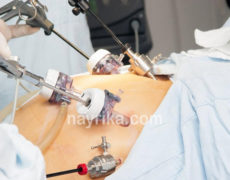 لاپاراسکوپی: روش انجام، عوارض و مراقبت های بعد از آن / لاپاراسکوپی و بارداری