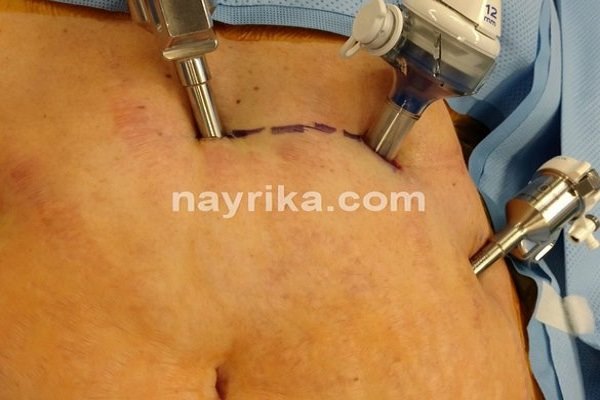 لاپاراتومی, لاپاراتومی چیست, عوارض لاپاراتومی, آمادگی قبل از عمل لاپاراتومی, مراقبت های بعد از عمل لاپاراتومی, مینی لاپاراتومی, لاپاراتومی کیست تخمدان, لاپاراتومی میومکتومی, عمل لاپاراتومی فیبروم, مراقبت های بعد از عمل لاپاراتومی کیست تخمدان, عمل لاپاراتومی شکم لاپاراتومی, لاپاراتومی چیست, عوارض لاپاراتومی, آمادگی قبل از عمل لاپاراتومی, مراقبت های بعد از عمل لاپاراتومی, مینی لاپاراتومی, لاپاراتومی کیست تخمدان, لاپاراتومی میومکتومی, عمل لاپاراتومی فیبروم, مراقبت های بعد از عمل لاپاراتومی کیست تخمدان, عمل لاپاراتومی شکم