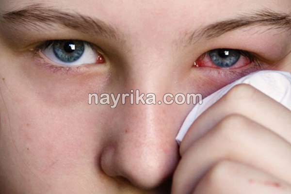 قرمزی چشم, علت قرمزی چشم, علت قرمزی چشم چپ, درمان قرمزی چشم, درمان قرمزی چشم در طب سنتی, قطره برای رفع قرمزی چشم, قرمزی زیر چشم نشانه چیست, درمان فوری قرمزی چشم, درمان سریع خونریزی چشم, رگه های قرمز در سفیدی چشم, اسم قطره برای قرمزی چشم قرمزی چشم, علت قرمزی چشم, علت قرمزی چشم چپ, درمان قرمزی چشم, درمان قرمزی چشم در طب سنتی, قطره برای رفع قرمزی چشم, قرمزی زیر چشم نشانه چیست, درمان فوری قرمزی چشم, درمان سریع خونریزی چشم, رگه های قرمز در سفیدی چشم, اسم قطره برای قرمزی چشم